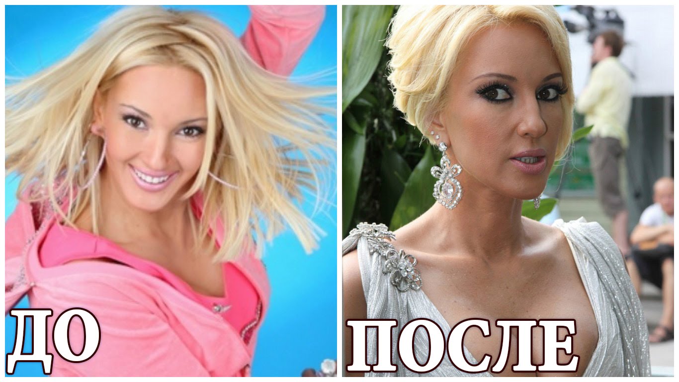 Ольга бузова фото до и после пластики